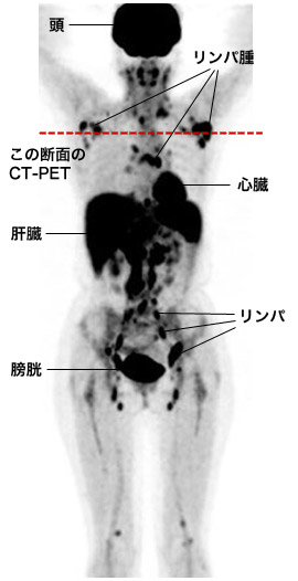 点線部分の断面が、右のPET・CT検査画像