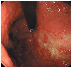 スキルス胃がんの内視鏡検査画像