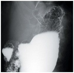 スキルス胃がんのエックス線検査画像