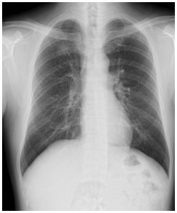 中分化型腺がんの胸部エックス線検査写真