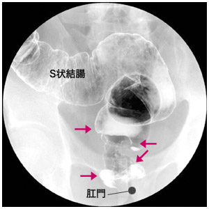 注腸エックス線検査画像