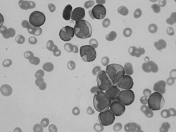 白血球数が51000の急性骨髄性白血病患者の血液標本