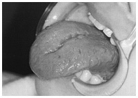 写真：表面が割れて溝ができた舌