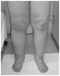 写真：子宮がん術後両下肢リンパ浮腫