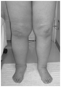 写真：子宮がん術後になった両下肢のリンパ浮腫