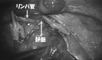 写真：細静脈リンパ管吻合術1
