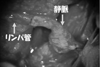 写真：細静脈リンパ管吻合術2