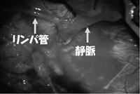 写真：細静脈リンパ管吻合術3