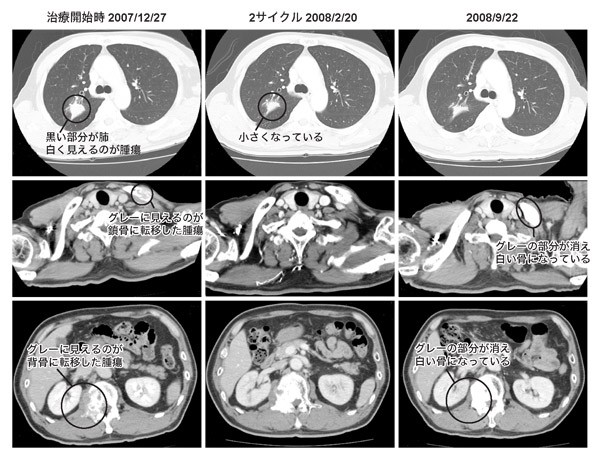 図2 右肺上葉腺がんAさんのCP+アバスチン療法の治療例