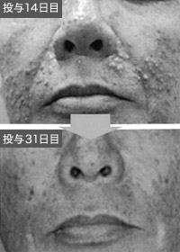 写真:アービタックスによるざ瘡様皮疹(50代・男性)