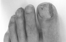 写真:アービタックスによる爪周囲炎(60代・男性)