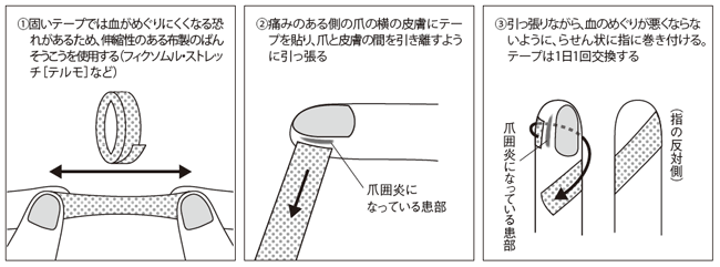 図：爪囲炎をケアするためのテーピング法