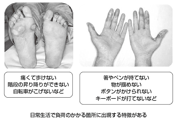 代表的な手足症候群の症状（ネクサバール、スーテント）