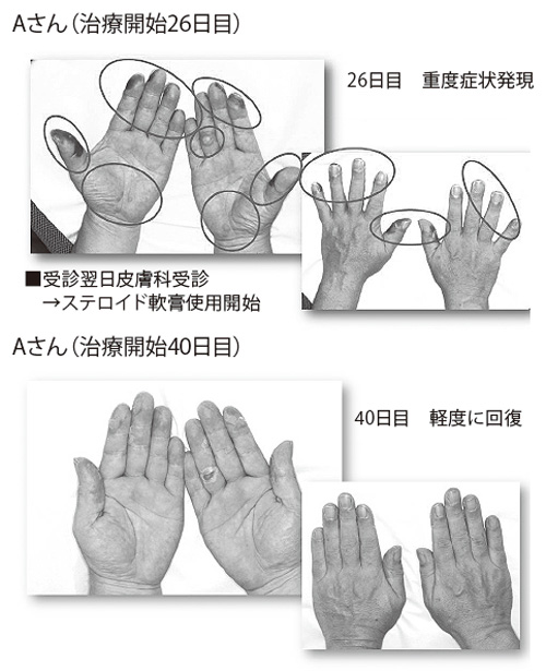手足症候群の症状の程度
