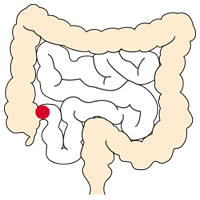 図：回腸ストーマ