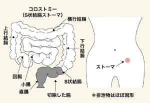 図1 コロストミー（S状結腸ストーマ）