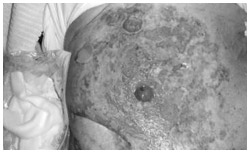 写真:水泡性天疱瘡による重度の皮膚障害