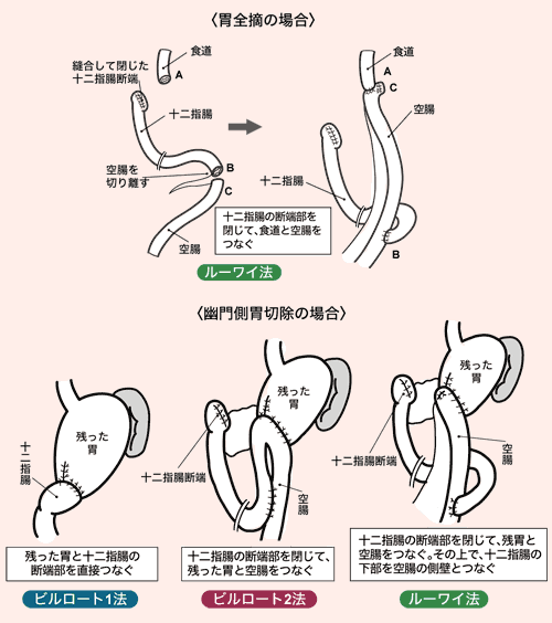 図：胃手術後の再建法