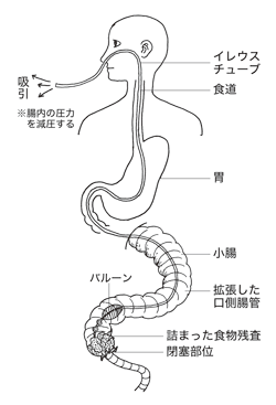 図4　イレウスチューブによる腸閉塞の治療