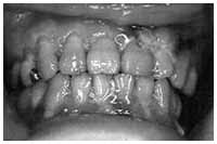 写真：緑膿菌感染症による歯肉壊死