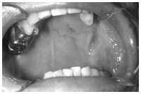 写真：放射線化学療法による口内炎