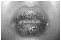 写真：骨髄移植後の口腔合併症