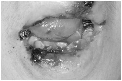 写真：抗がん剤による重症の口内炎