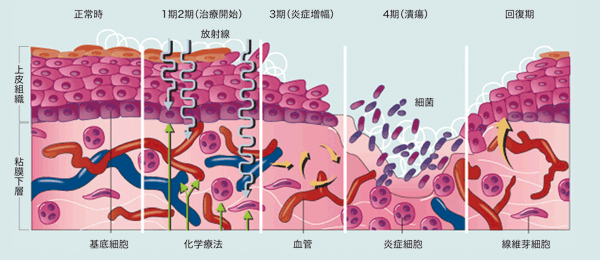 図1 放射線化学療法による口内炎の進行プロセス