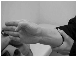 写真：ステロイド腱鞘内注後1週間後