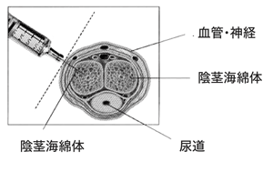 図：陰茎海綿体自己注射の仕方