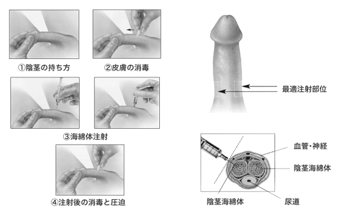 図：陰茎海綿体自己注射の仕方