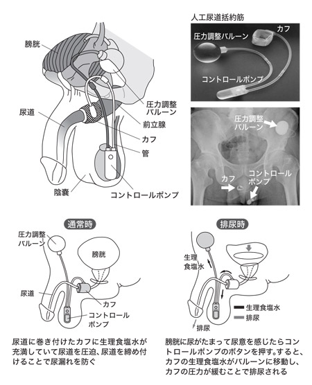 図：人工尿道括約筋の原理