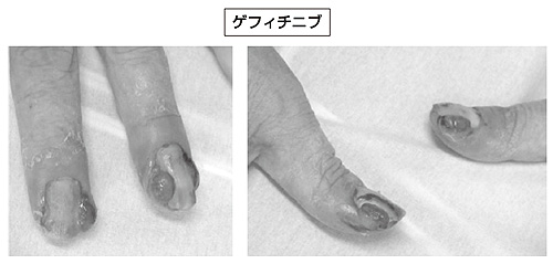 症例2 爪囲炎の症例