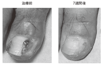 症例5 爪囲炎に対する液体窒素を用いた凍結療法(コットン・チップ法)