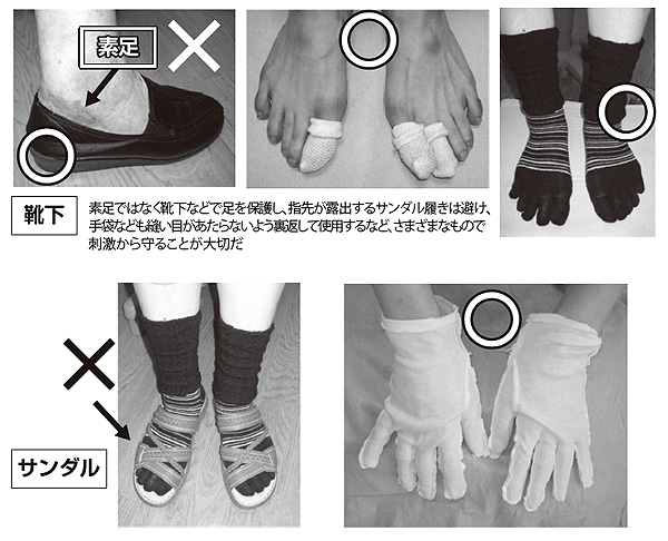 写真8 スキンケア(刺激からの手足の保護対策)
