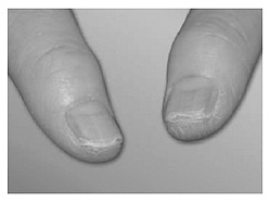図2 爪の症状と対処法