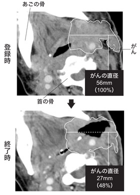 図:頭頸部がんが大幅に縮小した症例