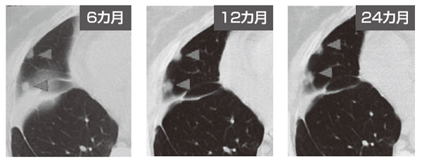 図3 肺がんに対するNKT細胞療法の効果