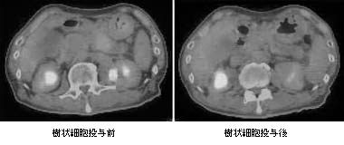 PET-CT