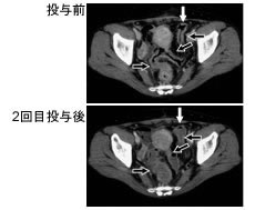 WT1ワクチンで乳がんの大腸転移巣が縮小した例