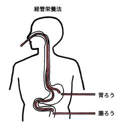 図3左：経管栄養法