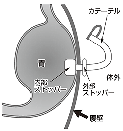 図6 胃ろうのメカニズム