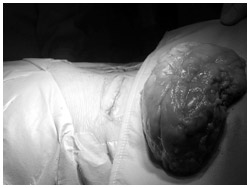 写真：腎臓を包む脂肪と共に摘出した右腎臓