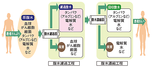 腹水濾過濃縮再静注法（CART法）のしくみ