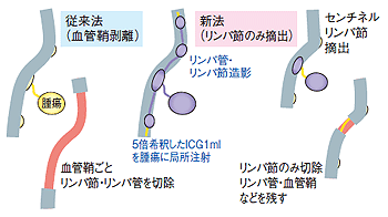 リンパ節切除術の準備