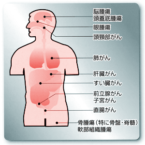 現在重粒子線治療を実施している部位