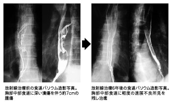 食道がん治療前後