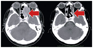 左篩骨洞がんの陽子線治療前後のCT画像