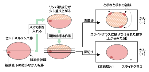 センチネルリンパ節生検のおとし穴