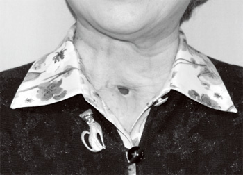 手術で頸部につくられた気管孔
